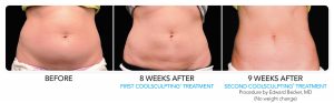 Coolsculpting 1