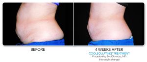 Coolsculpting 2
