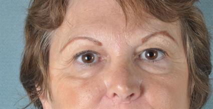 Before eyelid surgery