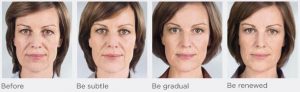 Before-to-After images from sculptraaesthetic.com