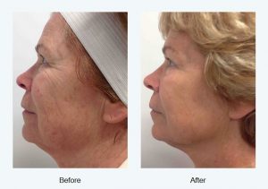10% off Infinite Skin Tightening Packages