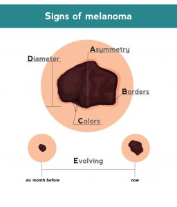 Melanoma ABCDE signs. Vector illustration of skin patch with skin cancer