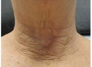 INFINI Case 30 Before | Azul Cosmetic Surgery and Medical Spa | Fort Myers FL INFINI Case 30 Before | Azul Cosmetic Surgery and Medical Spa | Fort Myers FL