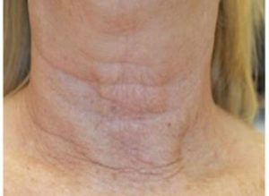 INFINI Case 30 After | Azul Cosmetic Surgery and Medical Spa | Fort Myers FL INFINI Case 30 After | Azul Cosmetic Surgery and Medical Spa | Fort Myers FL