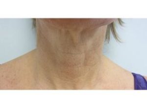INFINI Case 31 Before | Azul Cosmetic Surgery and Medical Spa | Fort Myers FL INFINI Case 31 Before | Azul Cosmetic Surgery and Medical Spa | Fort Myers FL