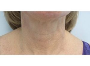 INFINI Case 31 After | Azul Cosmetic Surgery and Medical Spa | Fort Myers FL INFINI Case 31 After | Azul Cosmetic Surgery and Medical Spa | Fort Myers FL