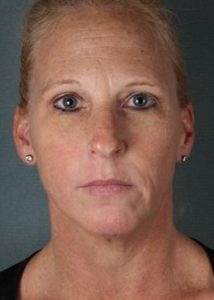 Juvederm Before & After Juvederm Before & After
