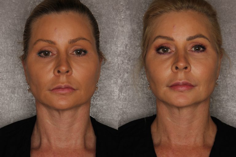 Silhouette InstaLift™ Fort Myers Skin Tightening Naples FL