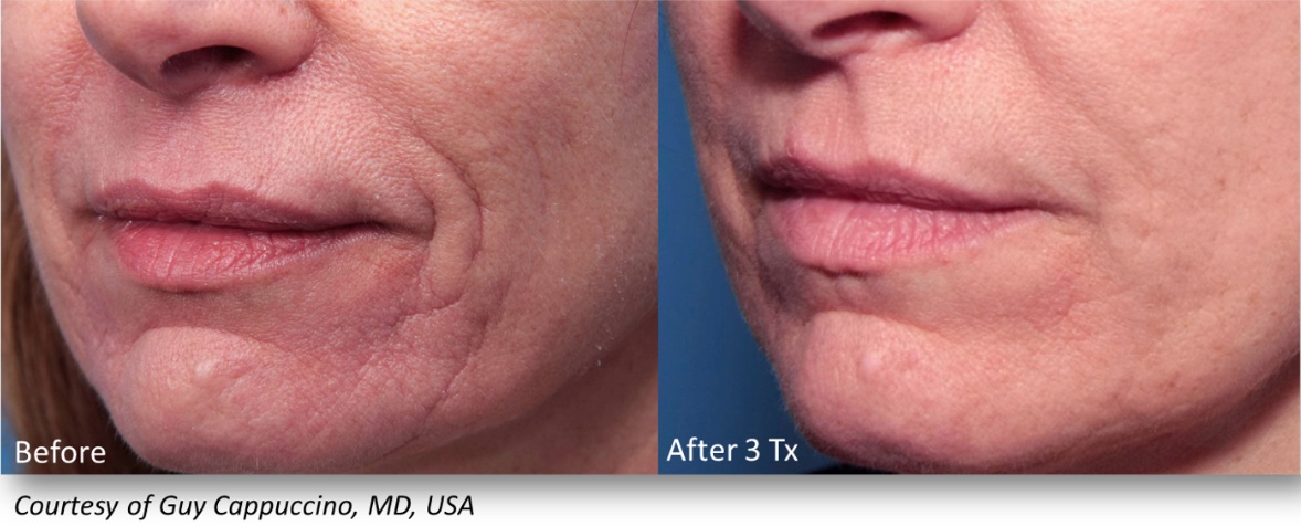 INFINI Before & After | Azul Cosmetic Surgery and Medical Spa | Fort Myers, FL INFINI Before & After | Azul Cosmetic Surgery and Medical Spa | Fort Myers, FL