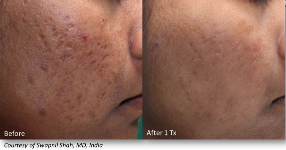 INFINI Before & After | Azul Cosmetic Surgery and Medical Spa | Fort Myers, FL INFINI Before & After | Azul Cosmetic Surgery and Medical Spa | Fort Myers, FL