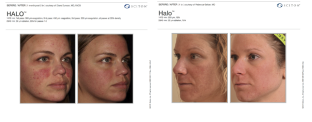 Halo before & after Halo before & after