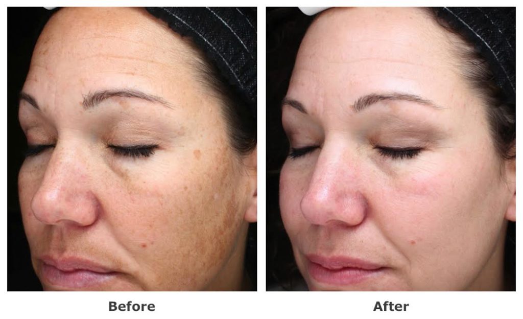 Halo Before & After Halo Before & After