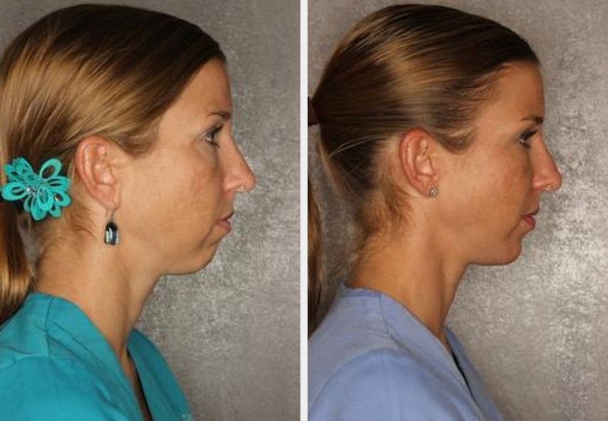 Dermal Fillers | Azul Cosmetic Surgery and Medical Spa | Naples, FL