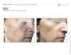 BBL Fort Myers FL | BBL Treatment Bonita Springs FL BBL Fort Myers FL | BBL Treatment Bonita Springs FL