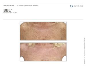 BBL Fort Myers FL | BBL Treatment Bonita Springs FL BBL Fort Myers FL | BBL Treatment Bonita Springs FL