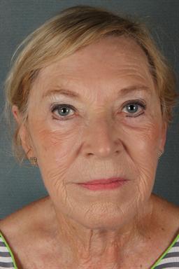After Sculptra | Azul Cosmetic Surgery and Medical Spa | Naples FL