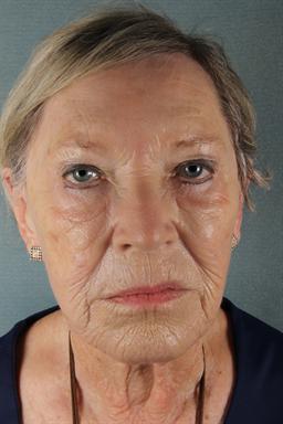 Before Sculptra | Azul Cosmetic Surgery and Medical Spa | Naples FL