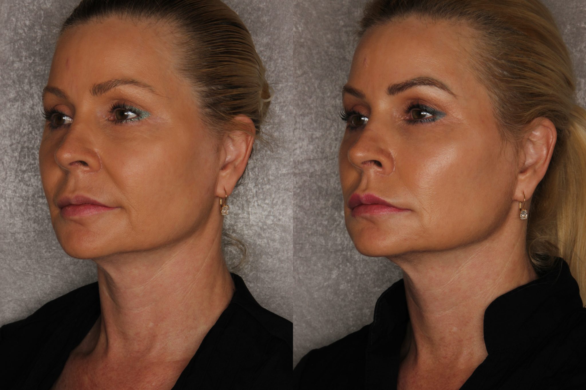 5 Big Benefits Of A Silhouette Instalift Infographic vrogue.co