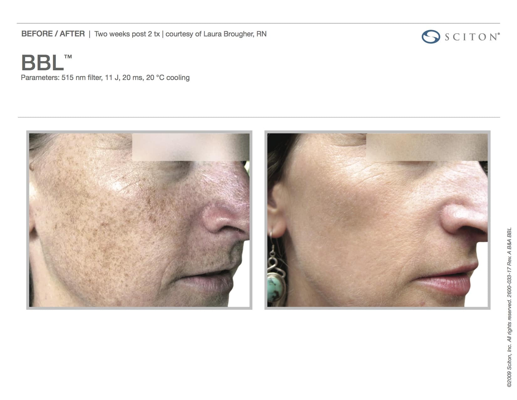 BBL Fort Myers FL | BBL Treatment Bonita Springs F