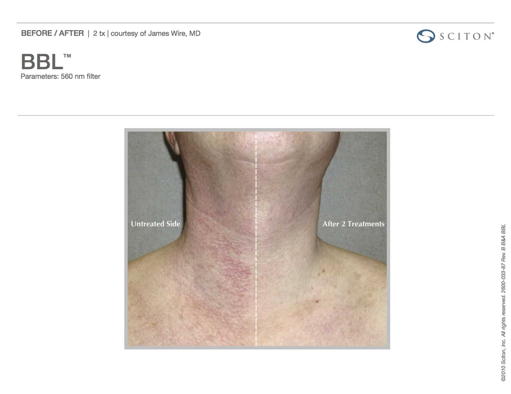 BBL Fort Myers FL | BBL Treatment Bonita Springs FL
