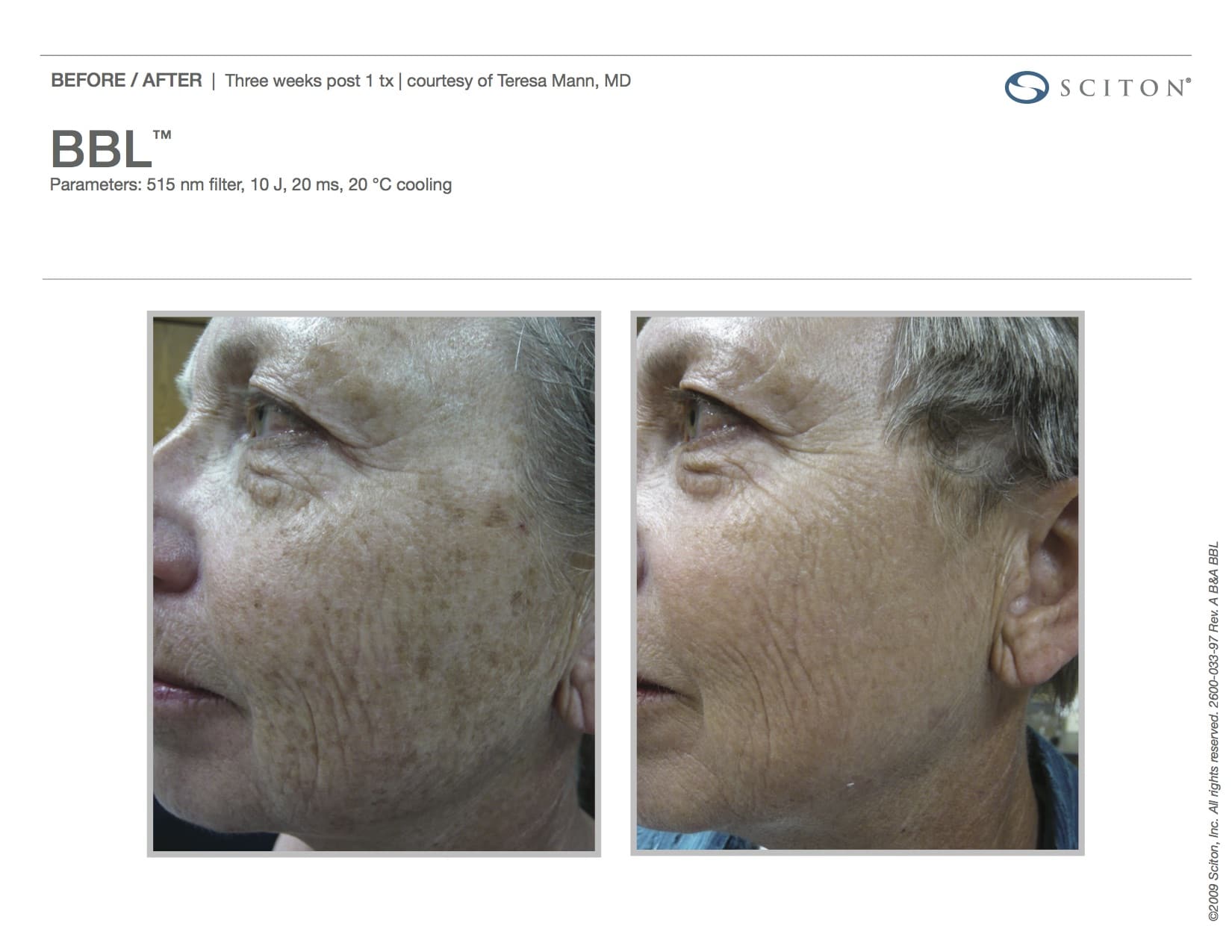 BBL Fort Myers FL | BBL Treatment Bonita Springs FL