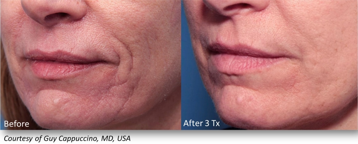 INFINI Before & After | Azul Cosmetic Surgery and Medical Spa | Fort Myers, FL INFINI Before & After | Azul Cosmetic Surgery and Medical Spa | Fort Myers, FL