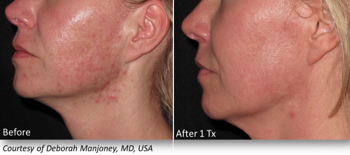 INFINI Before & After | Azul Cosmetic Surgery and Medical Spa | Fort Myers, FL INFINI Before & After | Azul Cosmetic Surgery and Medical Spa | Fort Myers, FL