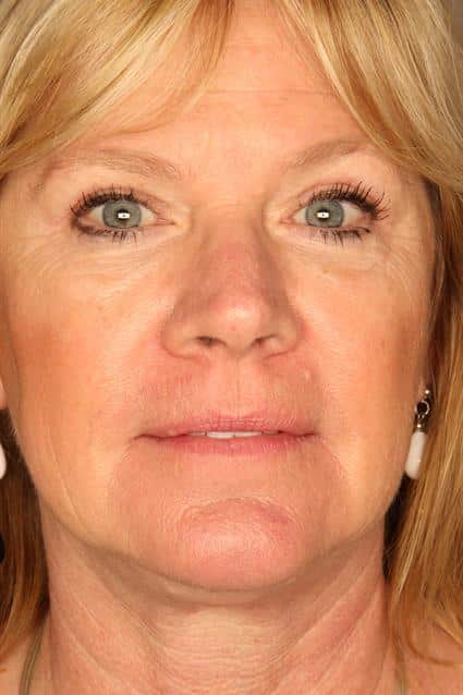 eyelid surgery after eyelid surgery after