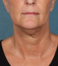 kybella 1 before