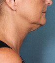 kybella 2 before