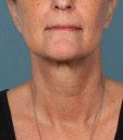 kybella 1 after