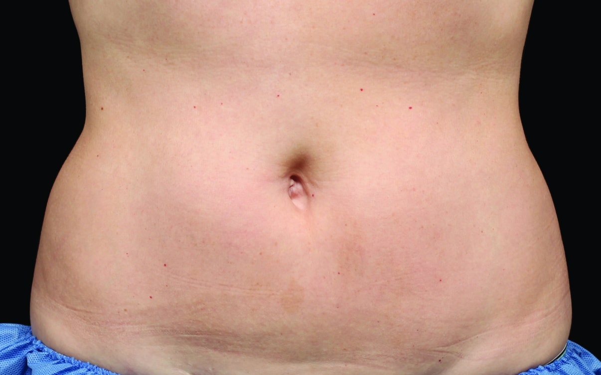 After CoolSculpting | Azul Cosmetic Surgery and Medical Spa | Naples FL