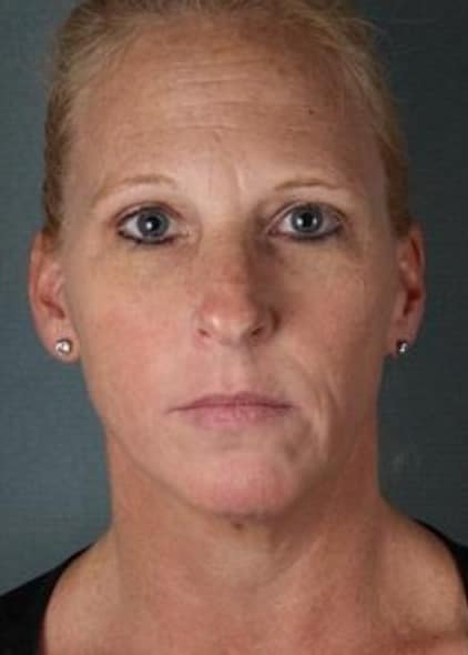 lady's face Before Botox | Naples FL BOTOX