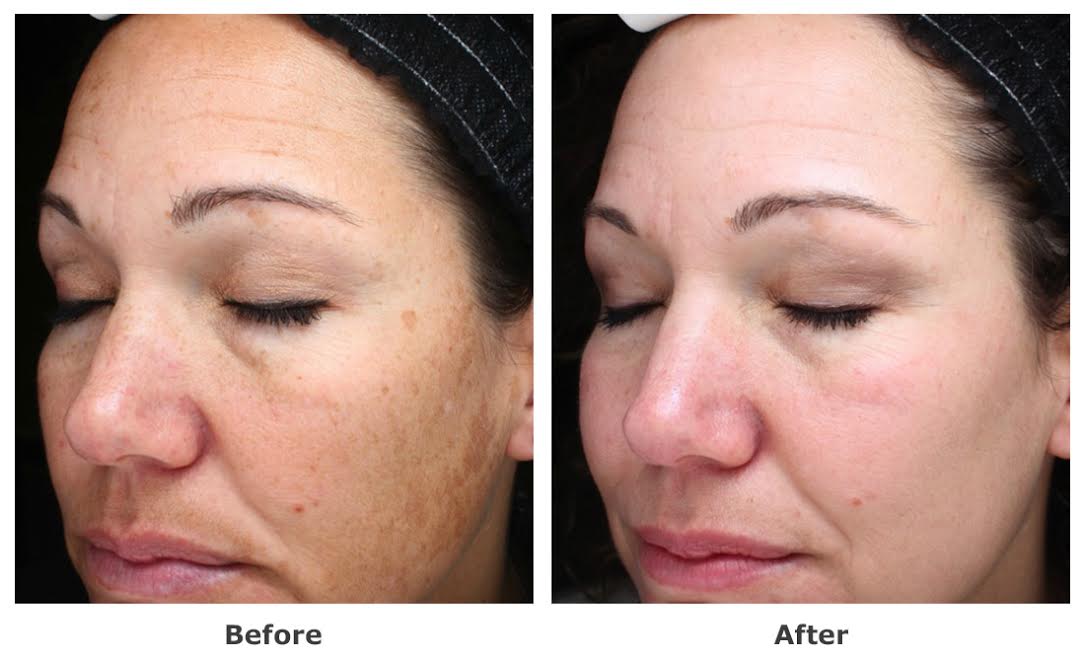 Before and After HALO Treatment