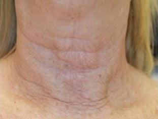 INFINI | Azul Cosmetic Surgery and Medical Spa | Fort Myers FL INFINI | Azul Cosmetic Surgery and Medical Spa | Fort Myers FL