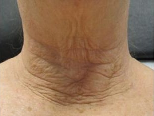 INFINI | Azul Cosmetic Surgery and Medical Spa | Fort Myers FL INFINI | Azul Cosmetic Surgery and Medical Spa | Fort Myers FL