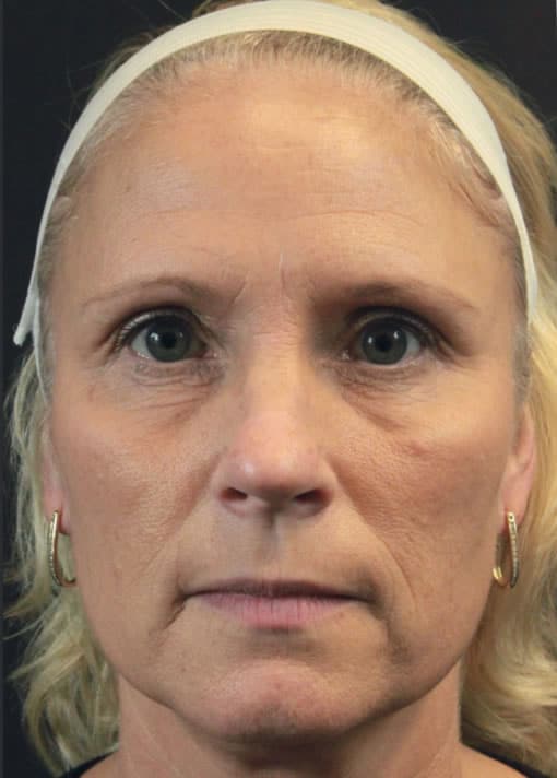 Instalift Fort Meyers, FL - lady's face before InstaLift