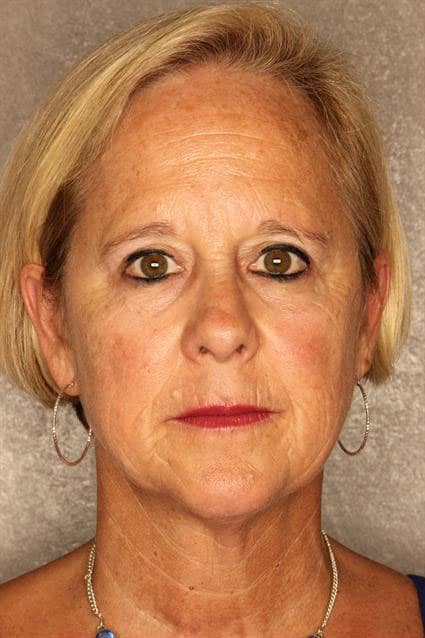 A liquid facelift before image of a woman