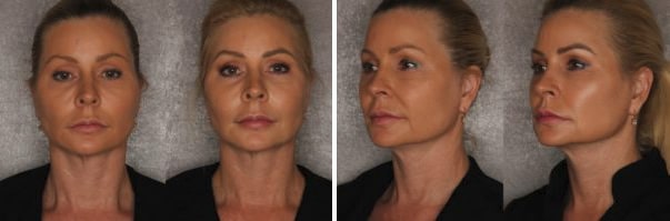 Instalift Before & After Fort Myers FL