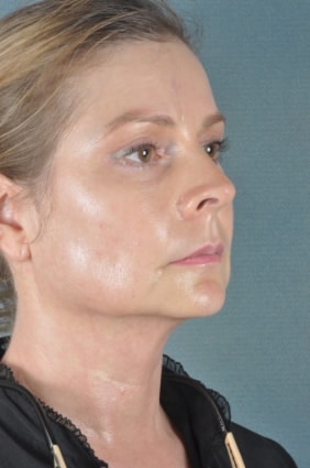 After Ultherapy | Azul Cosmetic Surgery and Medical Spa | Naples FL