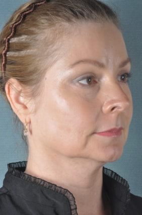 Before Ultherapy | Azul Cosmetic Surgery and Medical Spa | Naples FL
