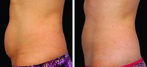coolsculpting prev
