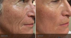 Microneedling Fort Myers, FL Microneedling Fort Myers, FL