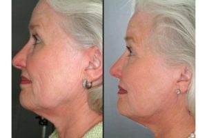 SkinPen Microneedling Naples, FL SkinPen Microneedling Naples, FL