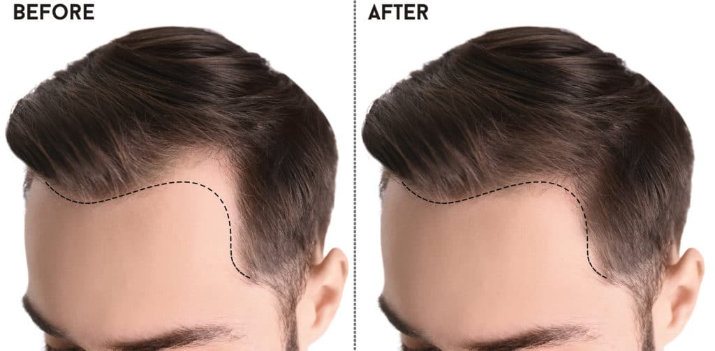 bigstock young man before and after hai 297660853