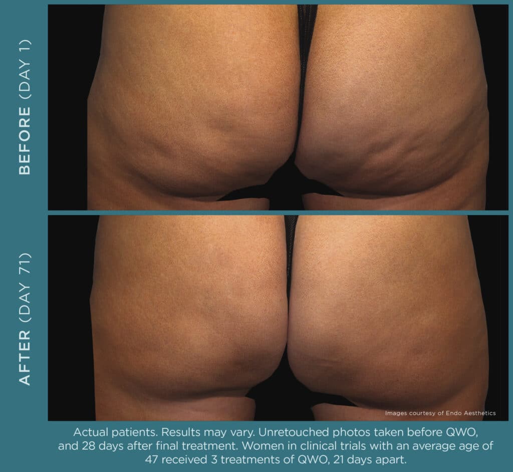 EA QW 05414 Before and After Photos R32