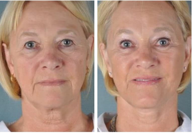 Almighty Achieve Dalset Endoscopic Brow Lift in Fort Myers | forehead lift in Naples, FL