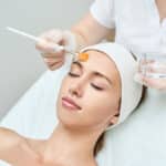 Chemical Peels