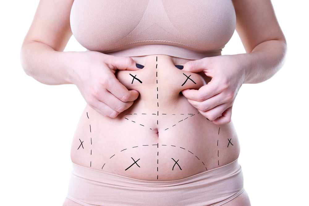 Liposuction,,Fat,And,Cellulite,Removal,Concept,,Overweight,Female,Body,With